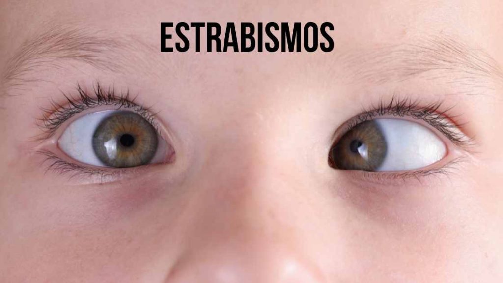 estrabismo